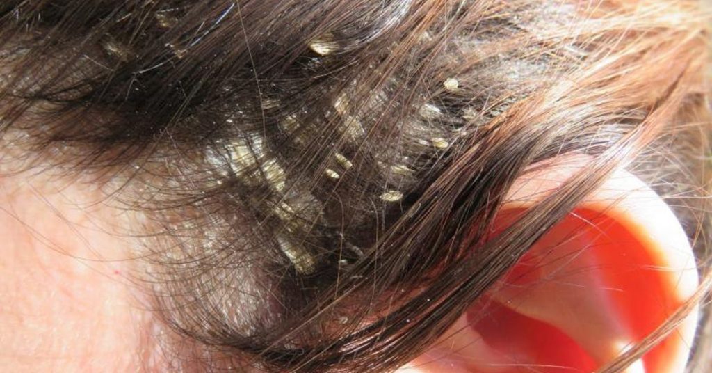 Лупа - Як користуватися оліями для волосся проти лупи?