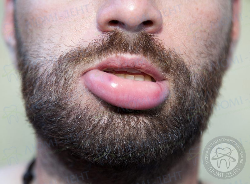 Набряклі губи - Які причини набряклих губ?