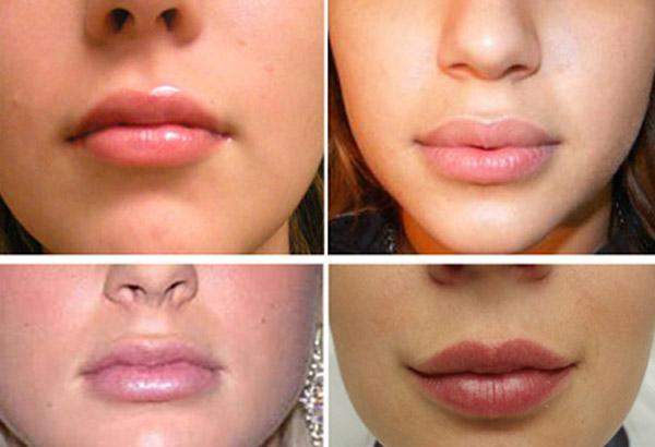 Операція на губах - Як доглядати за губами після операції