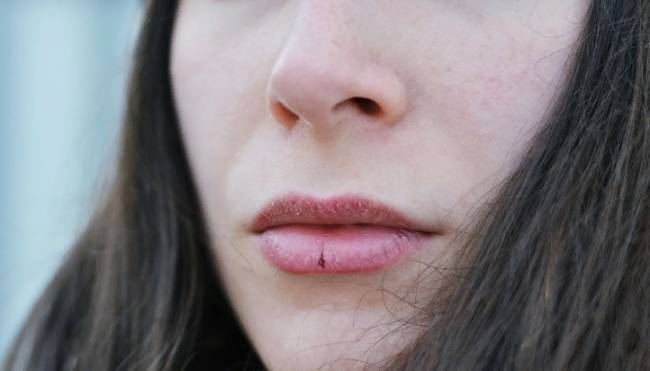 Потріскані губи - Як заспокоїти потріскані губи?