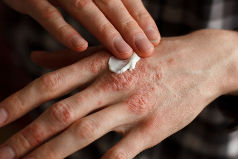 Псоріаз шкіри - Як лікувати псоріаз?