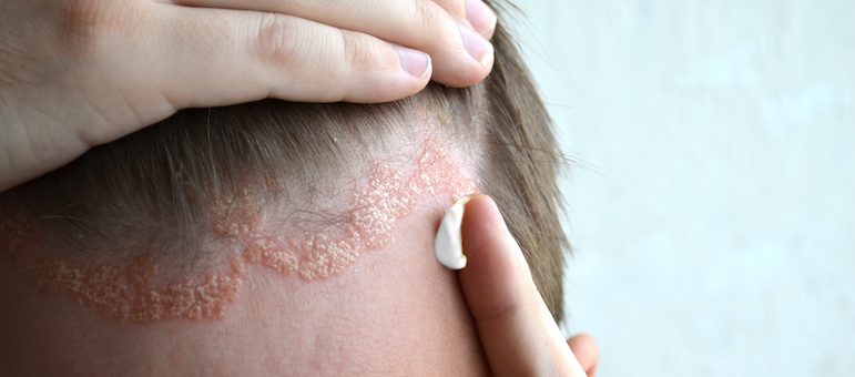 Псоріаз шкіри голови - Які симптоми та лікування псоріазу шкіри голови?
