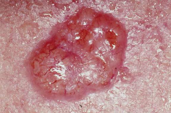 Рак шкіри - Які симптоми раку шкіри та лікування