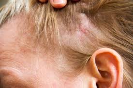 Шкіра - Як визначити та лікувати грибкову інфекцію шкіри голови?