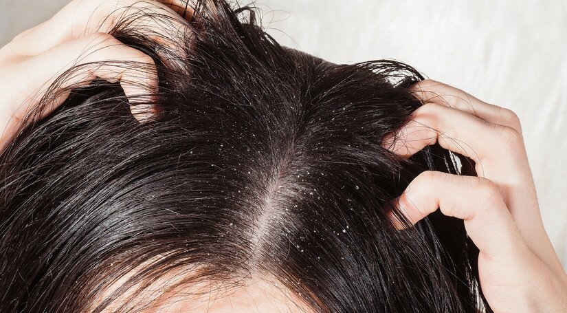 Шкіра голови - Як доглядати за сухою шкірою голови?