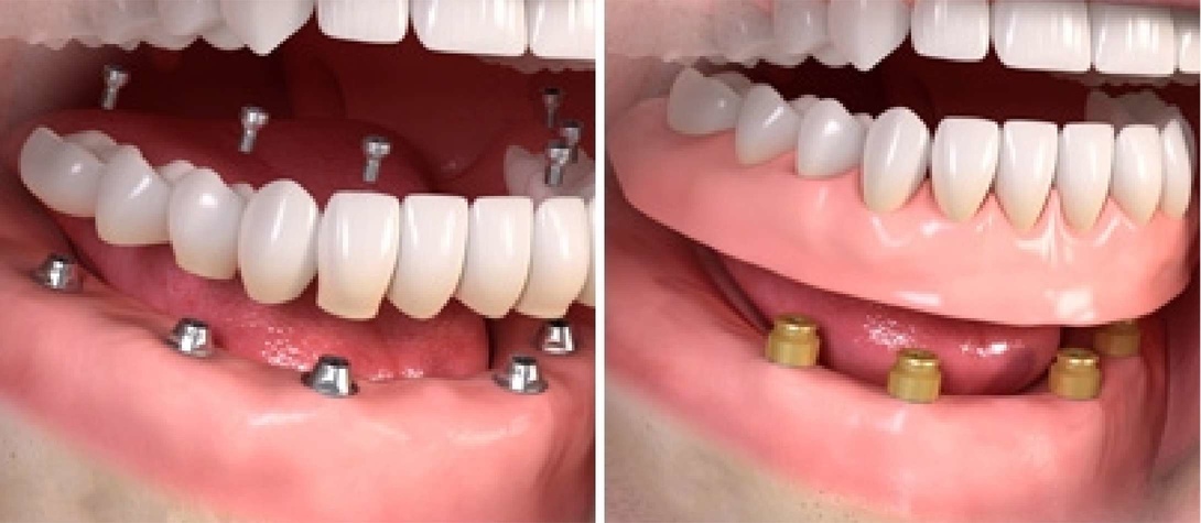 Що впливає на ціну імпланта зуба