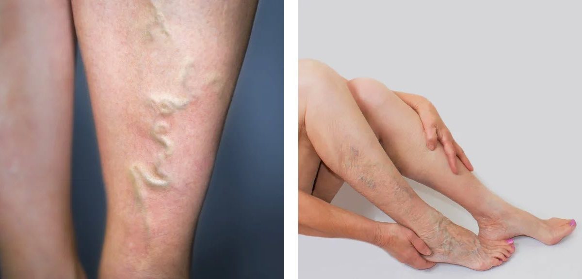 Когда может понадобиться консультация флеболога